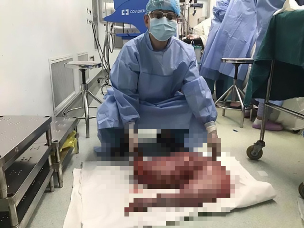 Bị táo bón bẩm sinh, anh chàng khiến các bác sĩ tá hỏa khi phẫu thuật cắt đoạn ruột chứa 13kg chất thải - Ảnh 2.