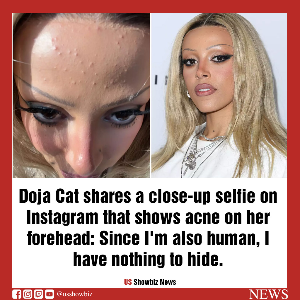 Doja Cat posts closeup selfie revealing forehead acne on Instagram I(01)