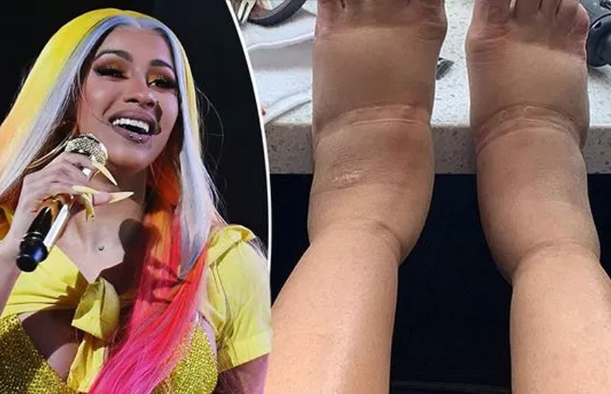 Cardi B reveals her feet are extremely swollen like balloons, fans are worried So her life is