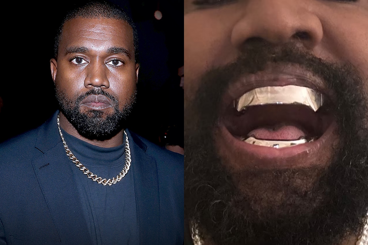 Kanye West has teeth REMOVED and replaced with $850K TITANIUM dentures ...