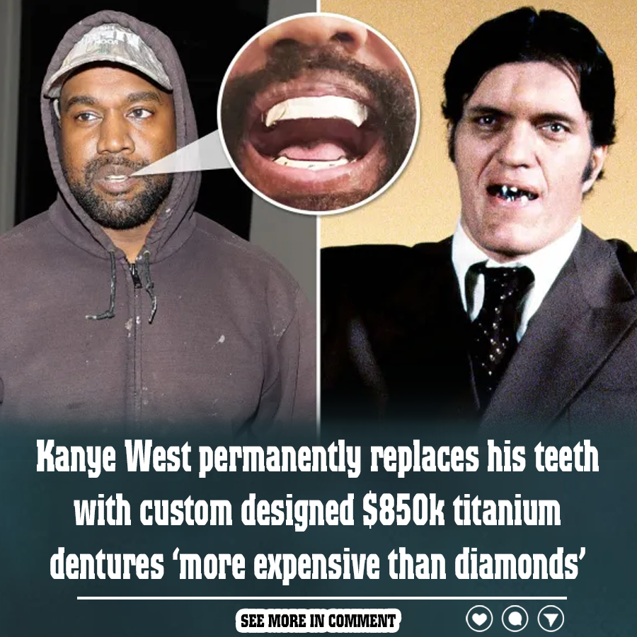 Kanye West Permanently Replaces His Teeth With Custom Designed 850k Titanium Dentures ‘more 9894